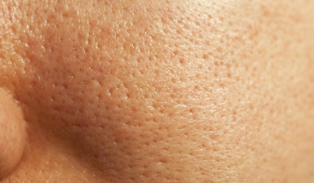 Tired of Large Pores? Here’s How to Make them Smaller﻿